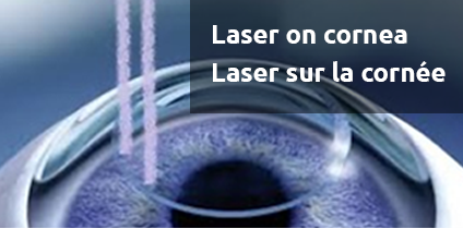 Application du laser sur la cornée